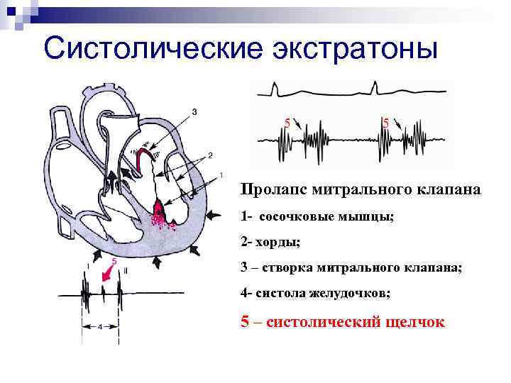 Систолические экстратоны 5 5 Пролапс митрального клапана 1 - сосочковые мышцы; 2 - хорды;