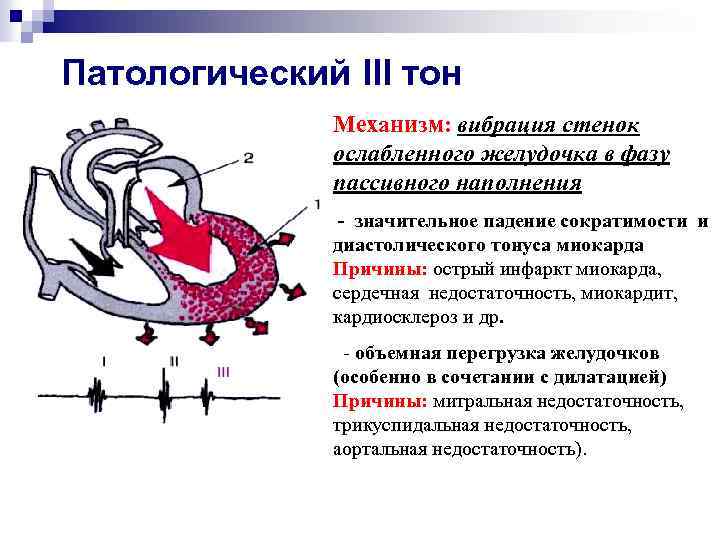 Патологический III тон Механизм: вибрация стенок ослабленного желудочка в фазу пассивного наполнения - значительное