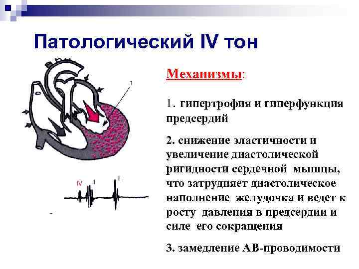 1 тон сердца. Патологический IV тон. Диастолическое наполнение сердца. Патологические тоны сердца. Аускультация сердца при гипертрофии левого желудочка.