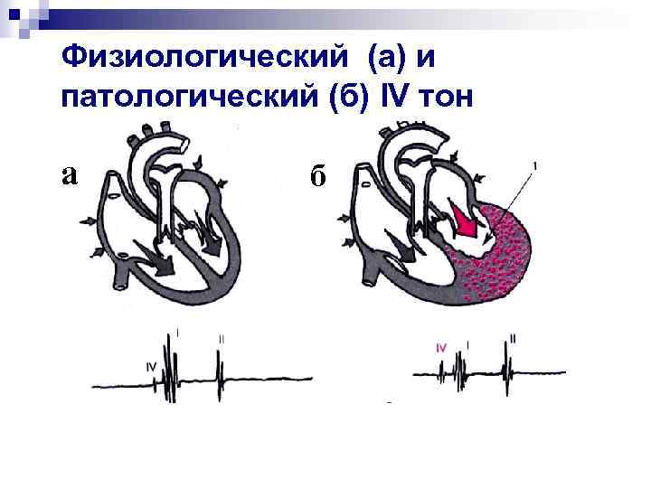 Физиологический (а) и патологический (б) IV тон а б 