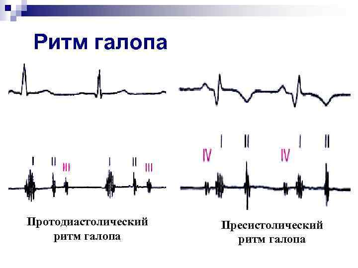 Ритм галопа Протодиастолический ритм галопа Пресистолический ритм галопа 