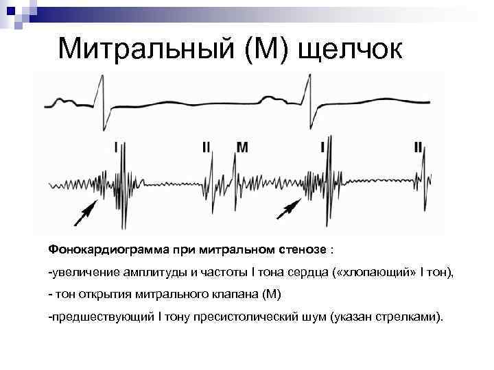 Митральный (М) щелчок Фонокардиограмма при митральном стенозе : -увеличение амплитуды и частоты I тона