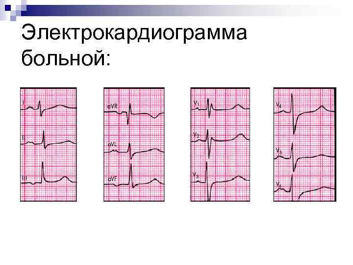 Электрокардиограмма больной: 