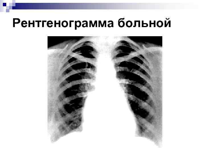 Рентгенограмма больной 