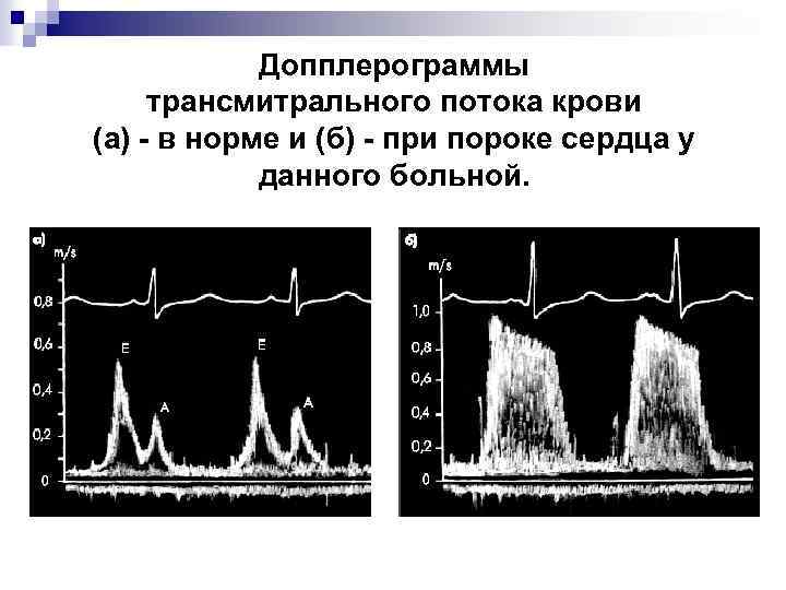 Допплерограммы трансмитрального потока крови (а) - в норме и (б) - при пороке сердца