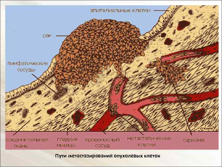 3. Метастазирование. Метастазы – это очаги отсева опухоли, метастазирование - сам процесс образования метастазов.