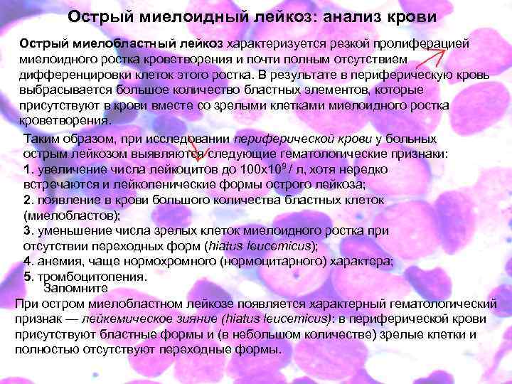 Острый миелоидный лейкоз: анализ крови Острый миелобластный лейкоз характеризуется резкой пролиферацией миелоидного ростка кроветворения