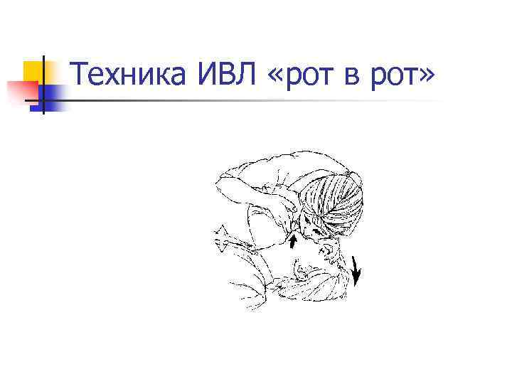 Техника ИВЛ «рот в рот» 