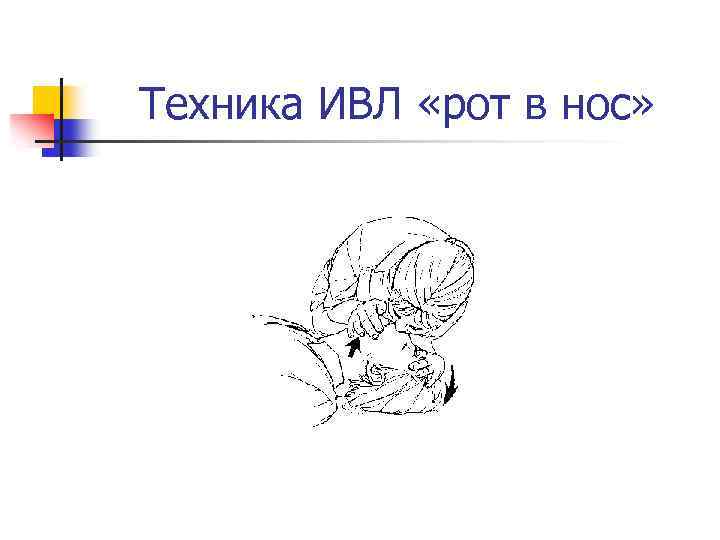 Техника ИВЛ «рот в нос» 