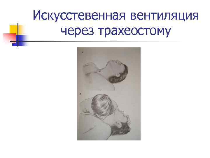 Искусстевенная вентиляция через трахеостому 