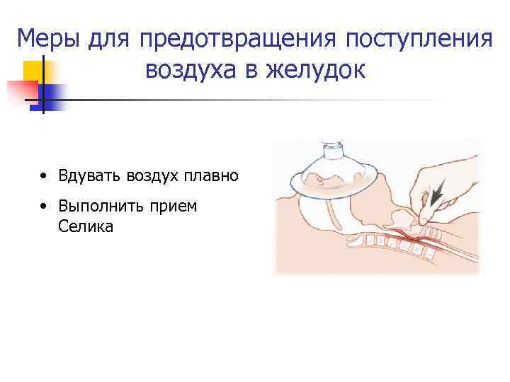 Меры для предотвращения поступления воздуха в желудок • Вдувать воздух плавно • Выполнить прием