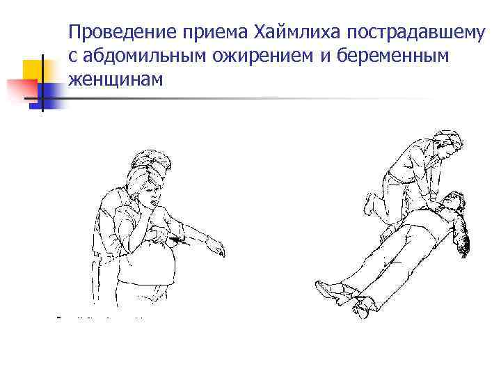 Проведение приема Хаймлиха пострадавшему с абдомильным ожирением и беременным женщинам 