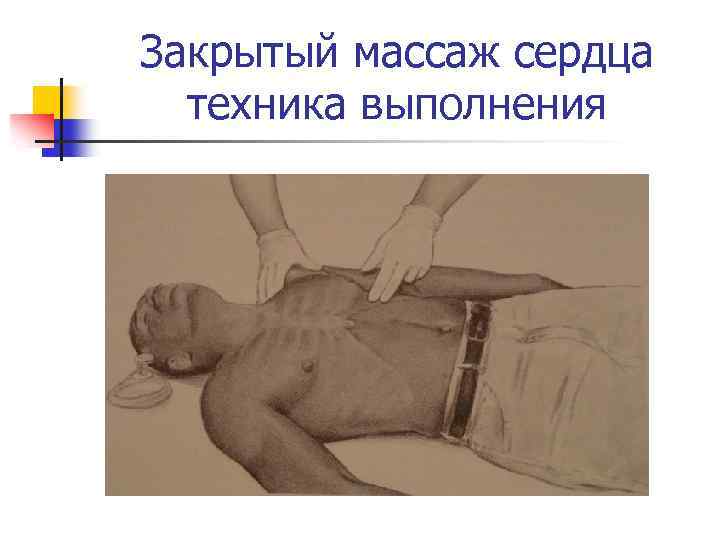 Закрытый массаж сердца техника выполнения 