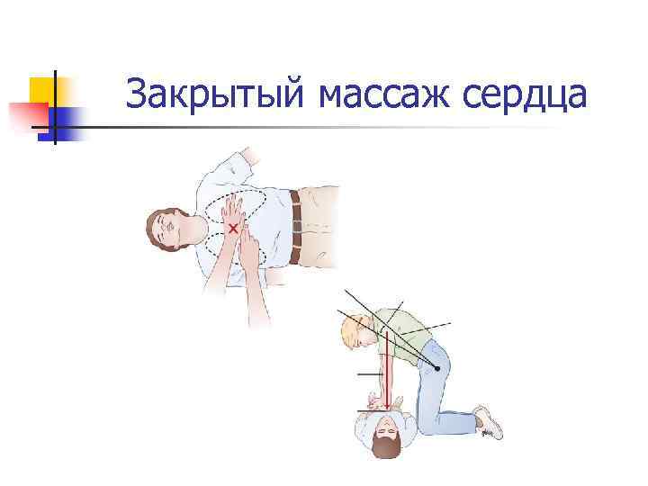 Закрытый массаж сердца 