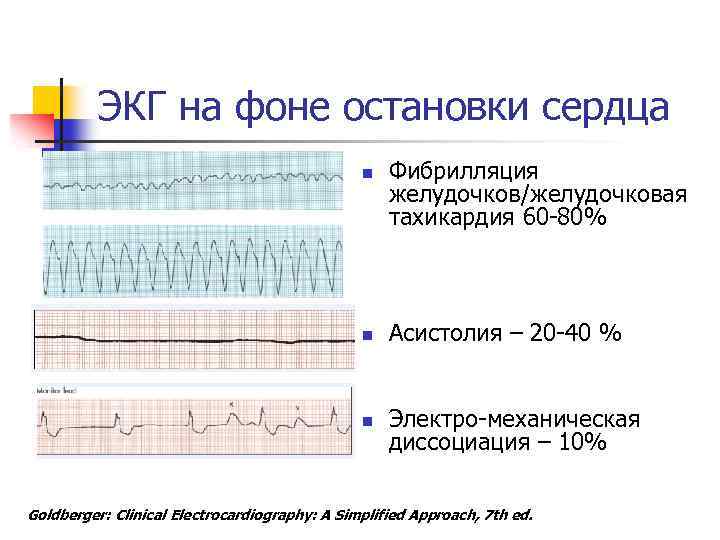 Признаки электромеханической диссоциации