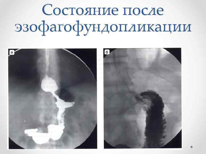 Состояние после эзофагофундопликации 