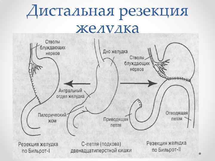 Дистальная резекция желудка 