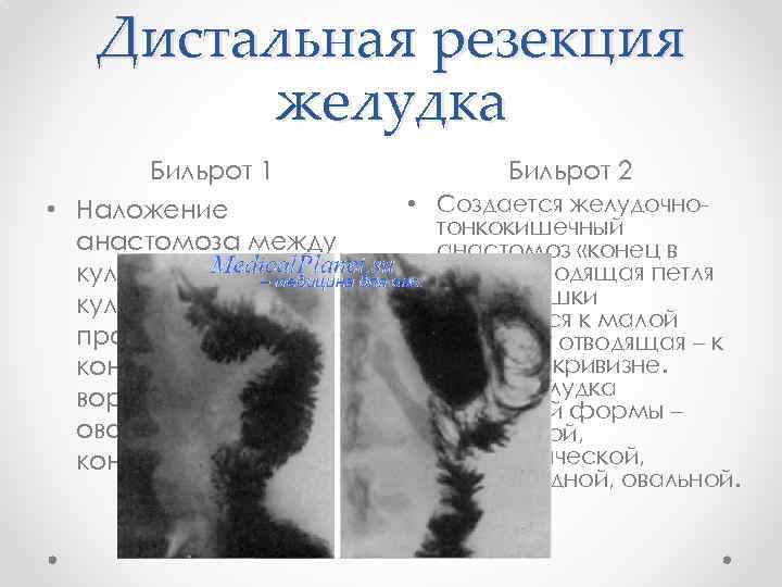 Дистальная резекция желудка Бильрот 1 Бильрот 2 • Наложение анастомоза между культей желудка и