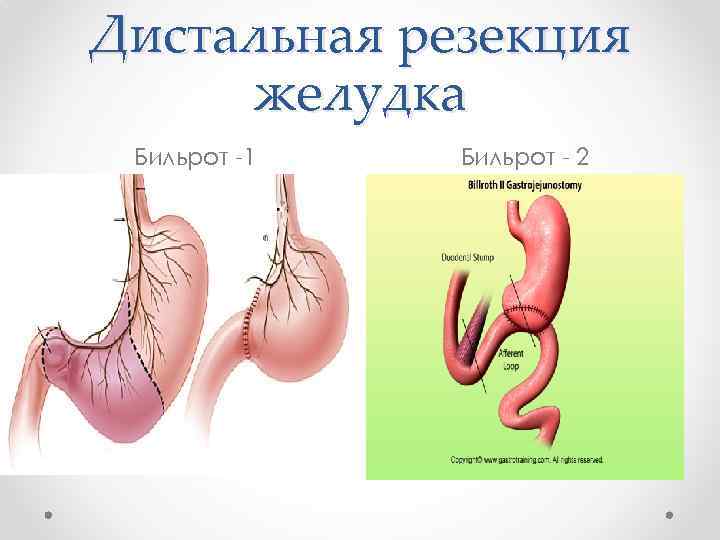 Резекция Желудка Для Похудения Цена В Новосибирске