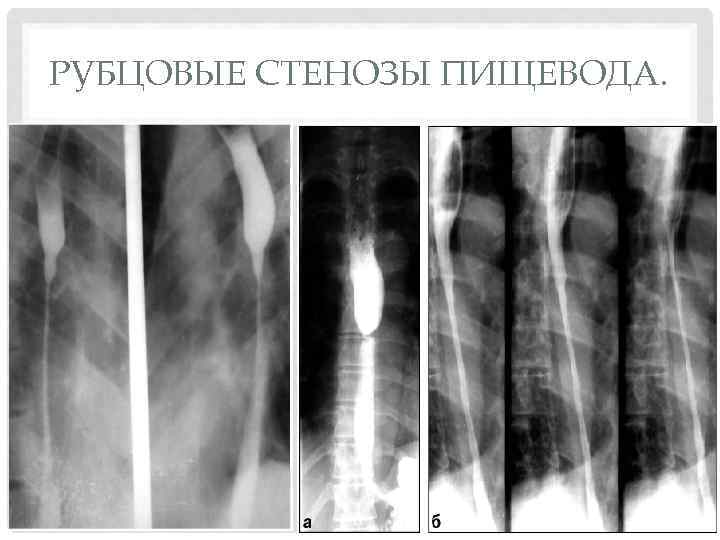 РУБЦОВЫЕ СТЕНОЗЫ ПИЩЕВОДА. 