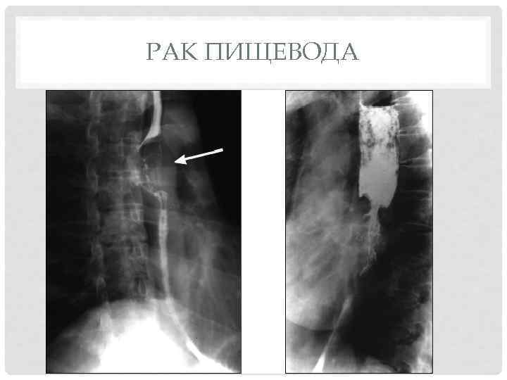 РАК ПИЩЕВОДА 