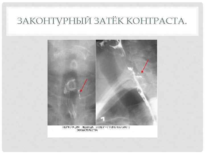 ЗАКОНТУРНЫЙ ЗАТЁК КОНТРАСТА. 