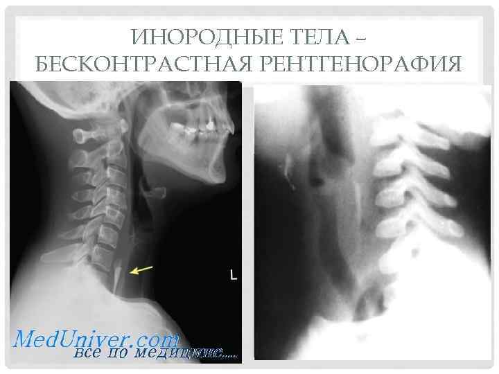 ИНОРОДНЫЕ ТЕЛА – БЕСКОНТРАСТНАЯ РЕНТГЕНОРАФИЯ 