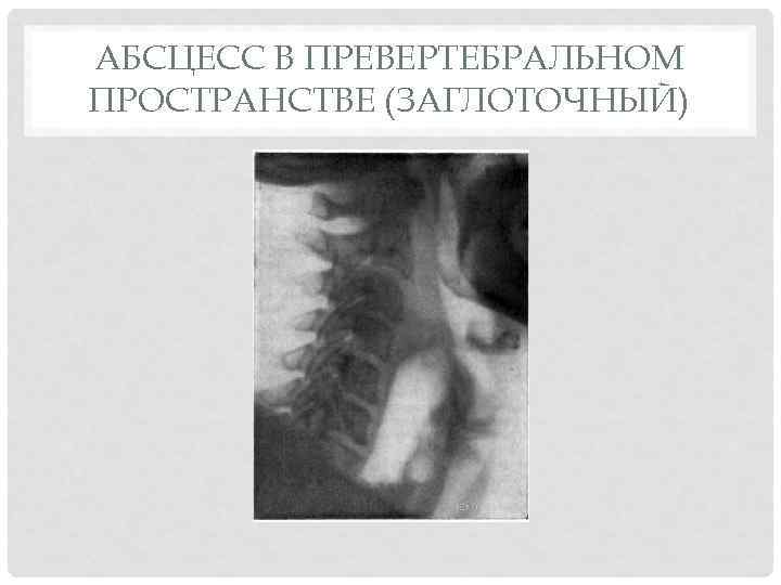 АБСЦЕСС В ПРЕВЕРТЕБРАЛЬНОМ ПРОСТРАНСТВЕ (ЗАГЛОТОЧНЫЙ) 