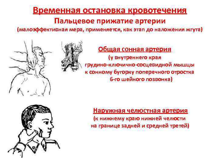 Временная остановка кровотечения Пальцевое прижатие артерии (малоэффективная мера, применяется, как этап до наложения жгута)