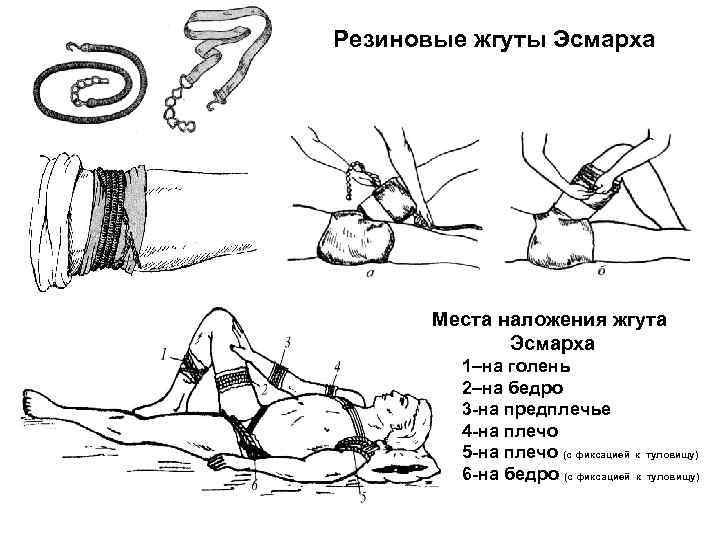 Резиновые жгуты Эсмарха Места наложения жгута Эсмарха 1–на голень 2–на бедро 3 -на предплечье