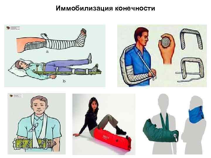 Иммобилизация конечности 