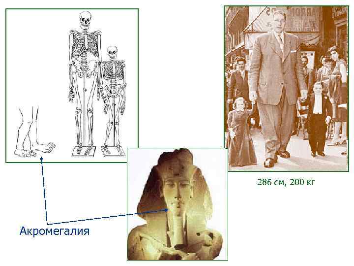 286 см, 200 кг Акромегалия 