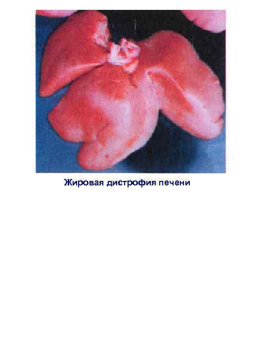 Жировая дистрофия печени 