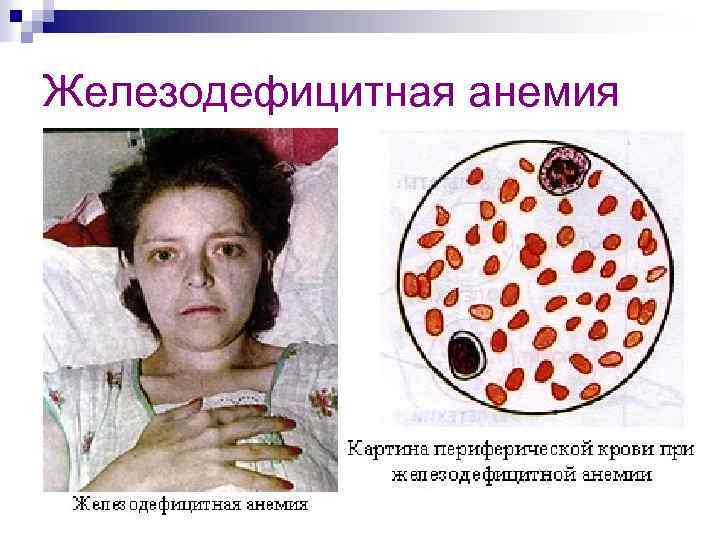 Железодефицитная анемия 