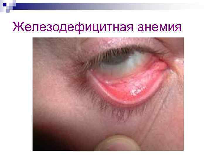 Железодефицитная анемия 