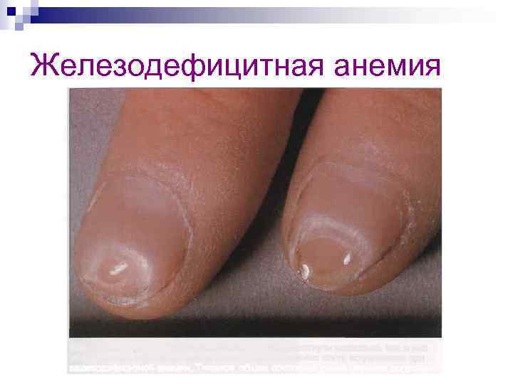 Железодефицитная анемия 