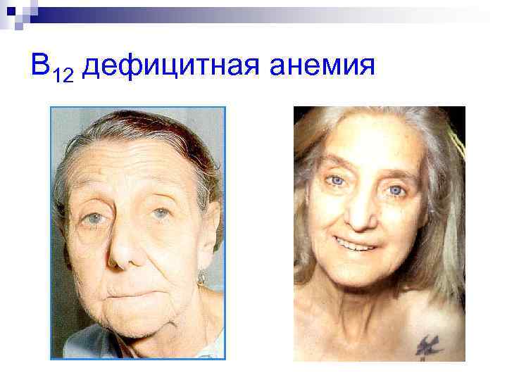 B 12 дефицитная анемия 