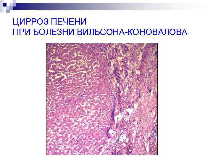 ЦИРРОЗ ПЕЧЕНИ ПРИ БОЛЕЗНИ ВИЛЬСОНА-КОНОВАЛОВА 