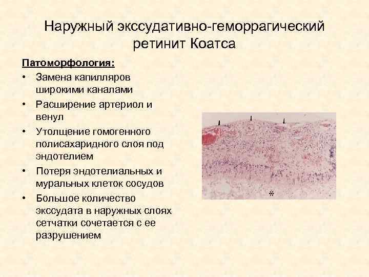 Наружный экссудативно-геморрагический ретинит Коатса Патоморфология: • Замена капилляров широкими каналами • Расширение артериол и