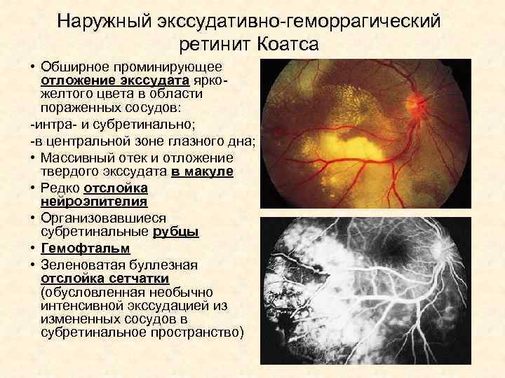 Очаг более вероятно сосудистого. Терминальная стадия ретинит Коатса.