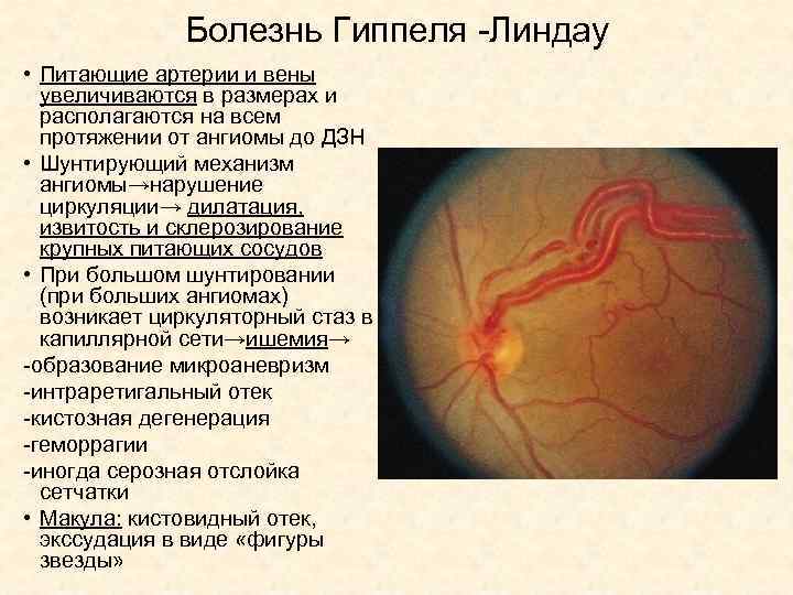 Болезнь Гиппеля -Линдау • Питающие артерии и вены увеличиваются в размерах и располагаются на