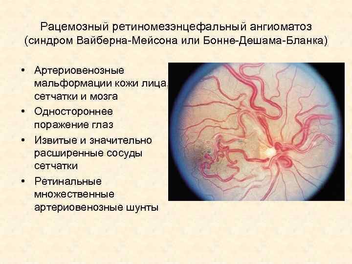 Рацемозный ретиномезэнцефальный ангиоматоз (синдром Вайберна-Мейсона или Бонне-Дешама-Бланка) • Артериовенозные мальформации кожи лица, сетчатки и