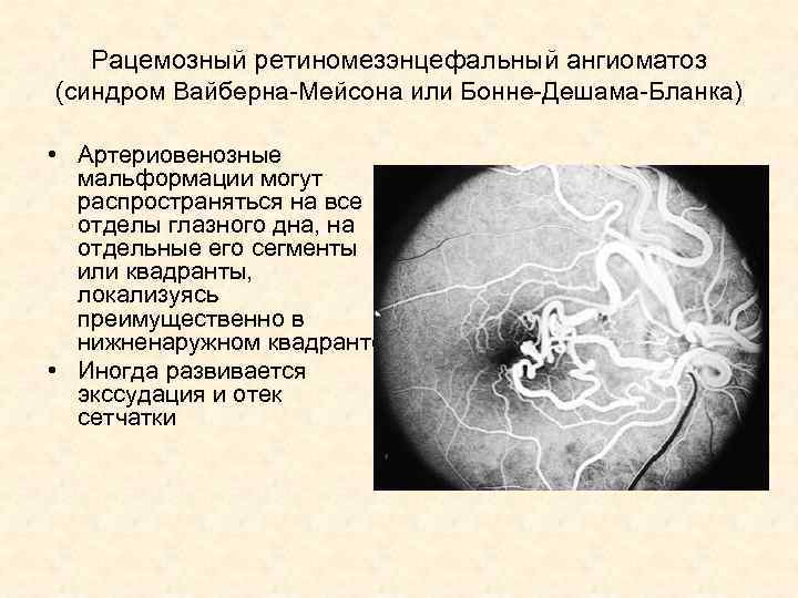 Рацемозный ретиномезэнцефальный ангиоматоз (синдром Вайберна-Мейсона или Бонне-Дешама-Бланка) • Артериовенозные мальформации могут распространяться на все