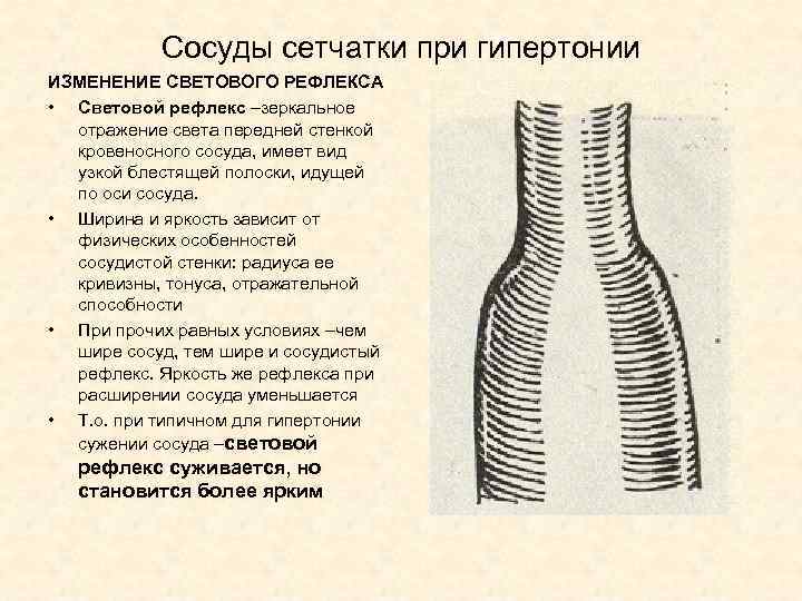 Сосуды сетчатки при гипертонии ИЗМЕНЕНИЕ СВЕТОВОГО РЕФЛЕКСА • Световой рефлекс –зеркальное отражение света передней