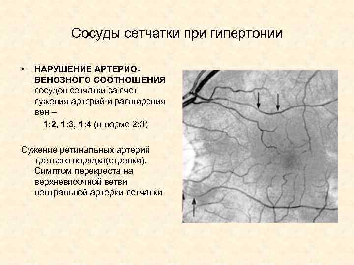 Сосуды сетчатки при гипертонии • НАРУШЕНИЕ АРТЕРИОВЕНОЗНОГО СООТНОШЕНИЯ сосудов сетчатки за счет сужения артерий