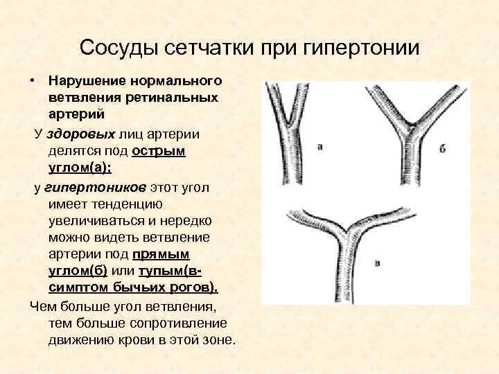 Сосуды сетчатки при гипертонии • Нарушение нормального ветвления ретинальных артерий У здоровых лиц артерии