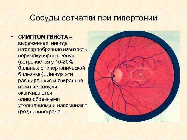 Сосуды сетчатки при гипертонии • СИМПТОМ ГВИСТА – выраженная, иногда штопорообразная извитость перимакулярных венул