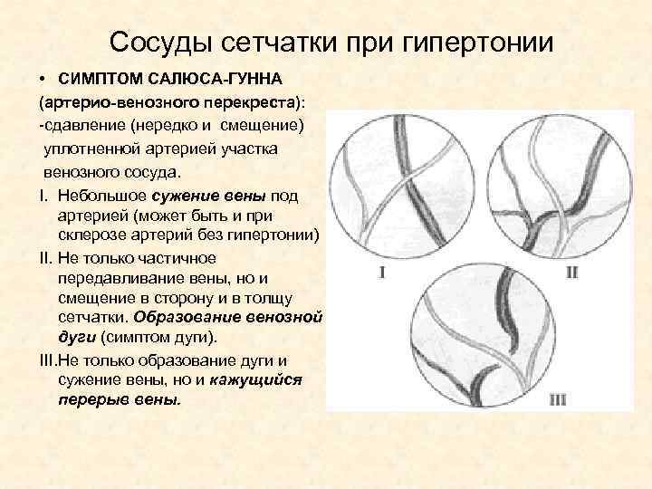 Сосуды сетчатки при гипертонии • СИМПТОМ САЛЮСА-ГУННА (артерио-венозного перекреста): -сдавление (нередко и смещение) уплотненной