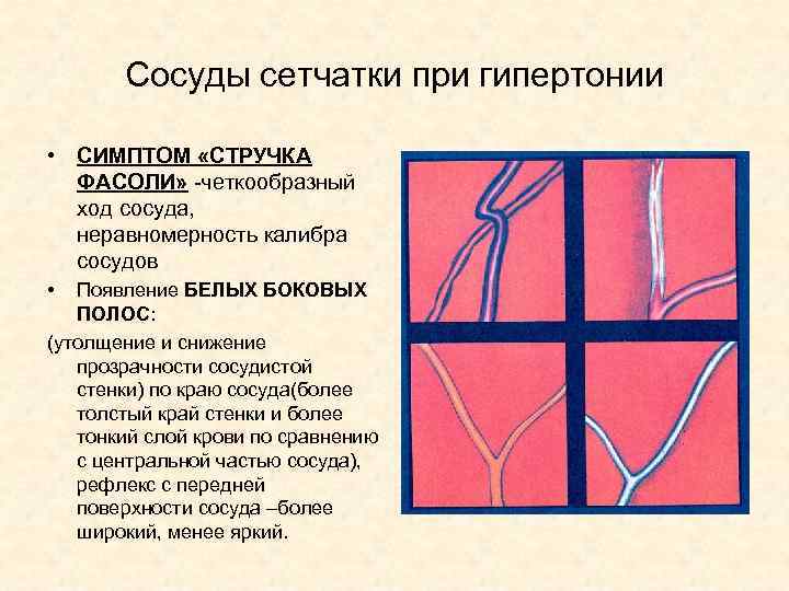 Сосуды сетчатки при гипертонии • СИМПТОМ «СТРУЧКА ФАСОЛИ» -четкообразный ход сосуда, неравномерность калибра сосудов