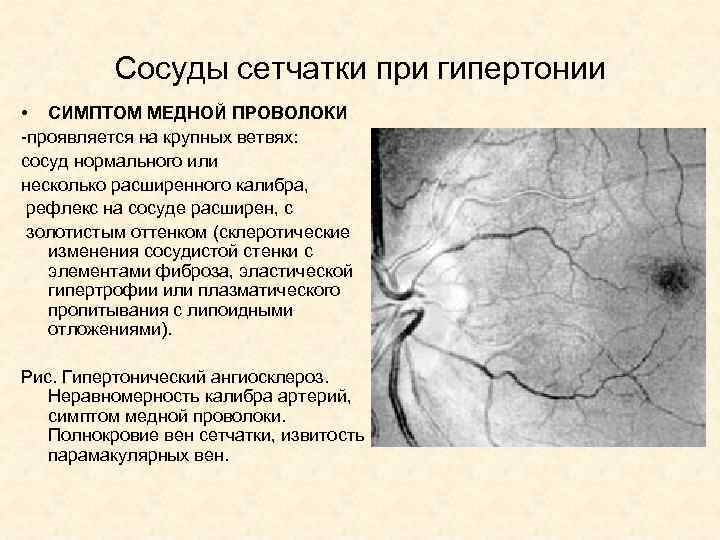 Сосуды сетчатки при гипертонии • СИМПТОМ МЕДНОЙ ПРОВОЛОКИ -проявляется на крупных ветвях: сосуд нормального